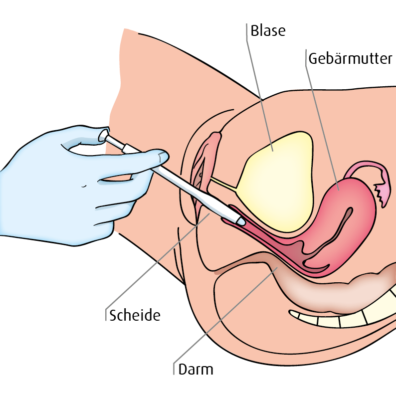 Applikator für Vaginalpräparate